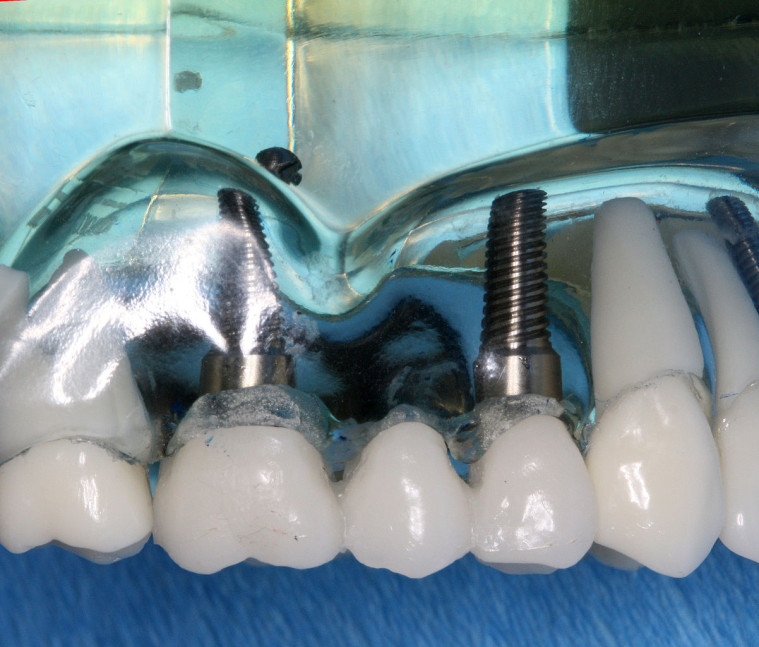 «Свершилось»: импланты из стволовых клеток помогут за 2 месяца вырастить новые зубы