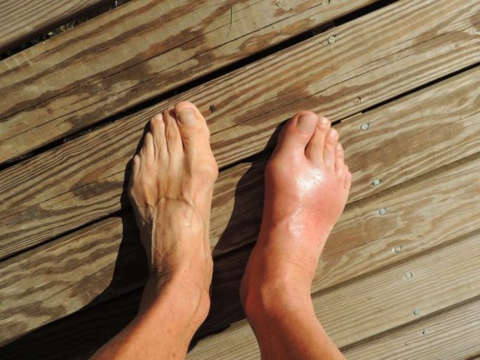 9 заболеваний, которые могут вызвать отёк ног